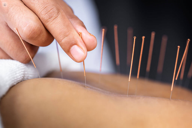 Acupuntura